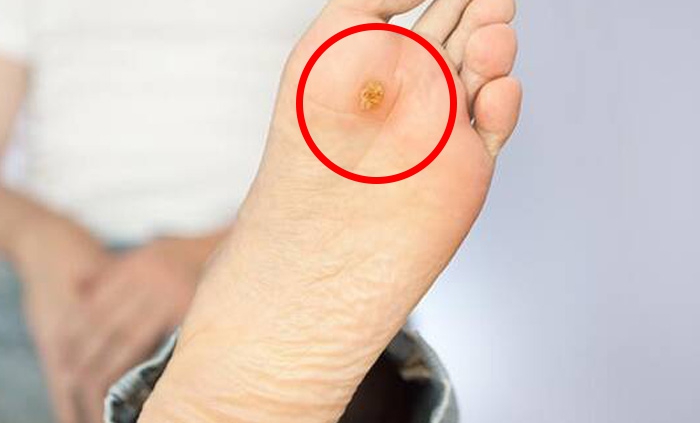 زخم پای دیابتی و علل و درمان