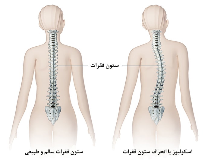 علائم انحراف ستون فقرات با توجه به تصویر 